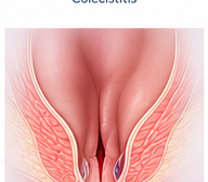 Ilustración médica de Fisura anal